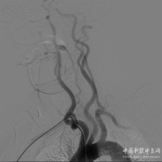 常寧市人民醫(yī)院開展經(jīng)橈動脈入路全腦血管造影